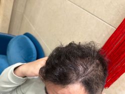 点击看大图 -碧莲盛·不剃发植发