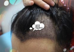 -大麦微针植发全国连锁