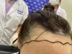 -碧莲盛·不剃发植发