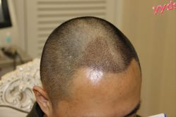 -大麦微针植发丨全国连锁