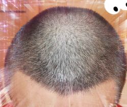 -大麦微针植发全国连锁