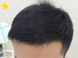 -大麦微针植发丨全国连锁