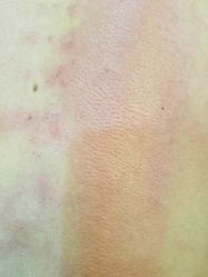 -苗方清颜专业祛痘养生