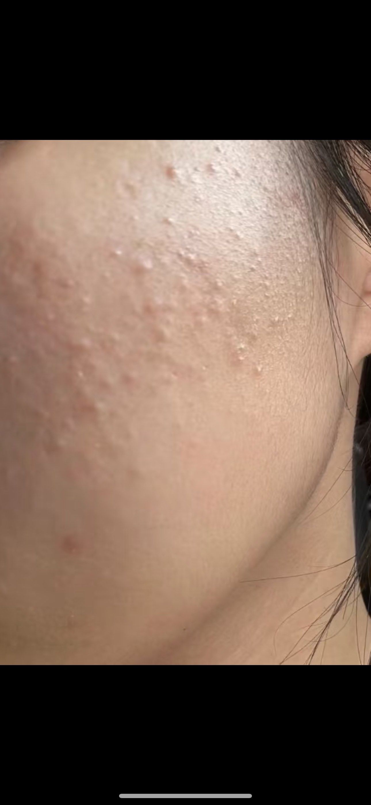 闭合性粉刺产生的原因 
1,皮肤干燥