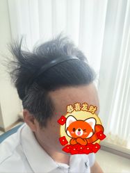 -大麦微针植发丨全国连锁