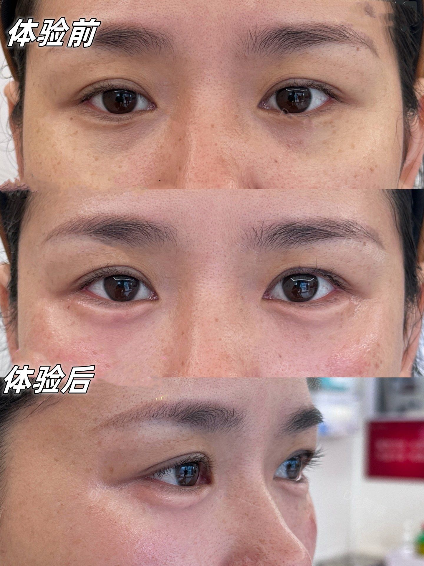 泪沟黑眼圈填充前后对比