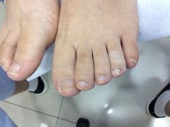 -德哥灰指甲脚气甲沟炎跖疣护理