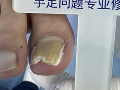 -Andrew指甲专科灰指甲·甲沟炎矫正·3D步态矫形鞋垫定制(浦三路店)