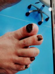 -足太医扦脚·灰指甲·嵌甲