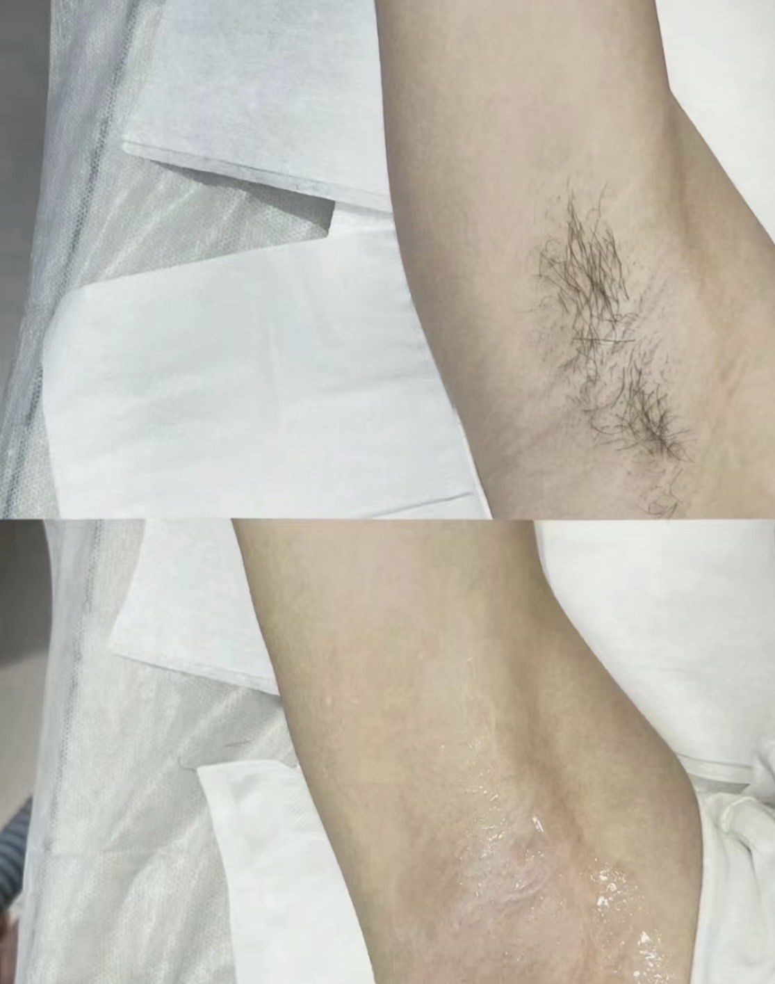腋下脱毛