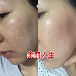 -美丽人生祛斑扁平疣汗管瘤中心