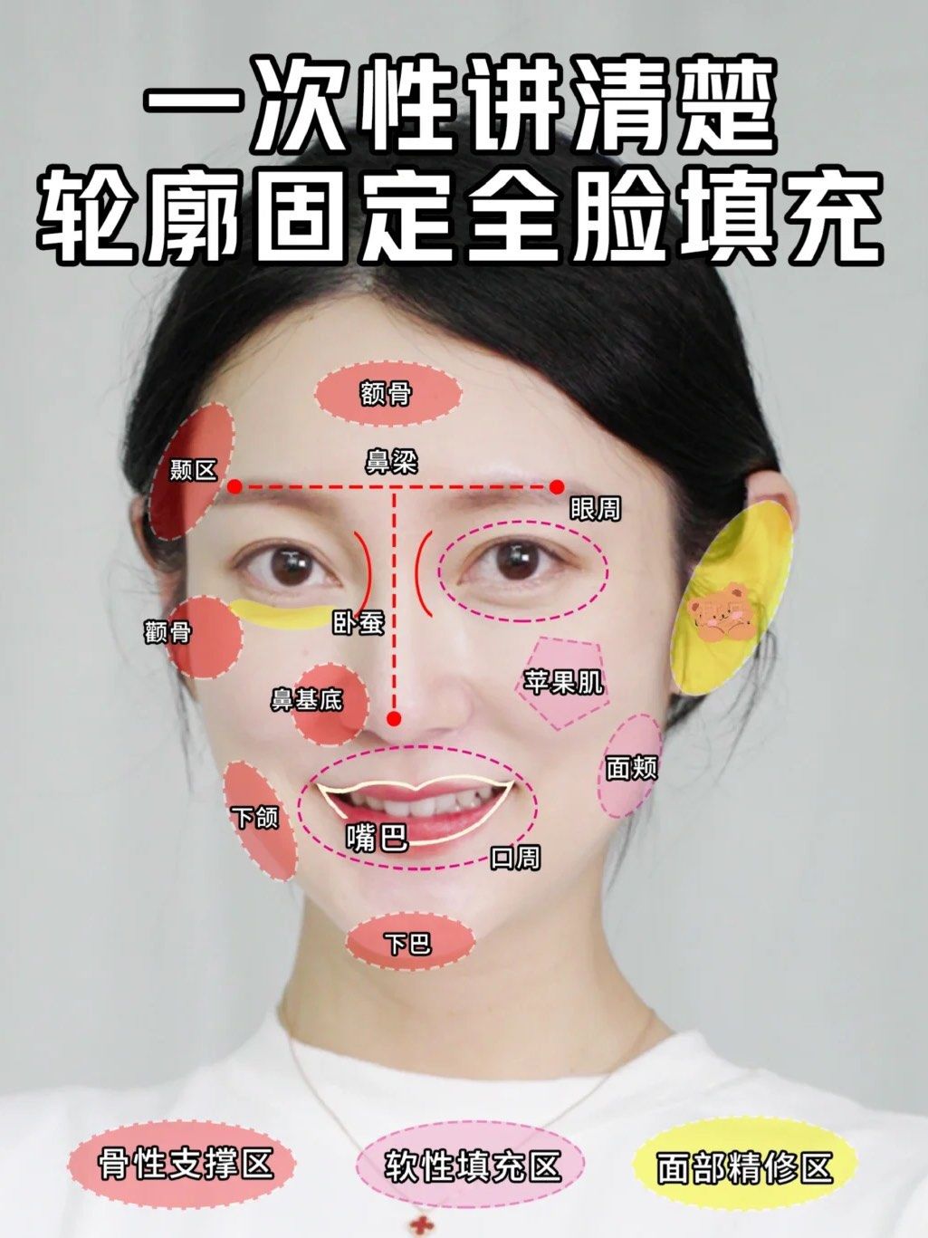 💡🔴面部轮廓固定区域一般分为:骨性支撑区,软性填充区,面部精