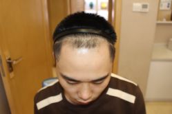 -大麦微针植发丨全国连锁