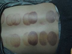 -中医推拿(永兴佳园店)