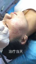 -爱莎扁平疣·汗管瘤·斑痣中心