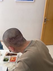 -大麦微针植发丨全国连锁