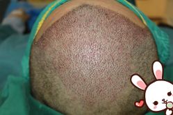 点击看大图 -大麦微针植发丨全国连锁