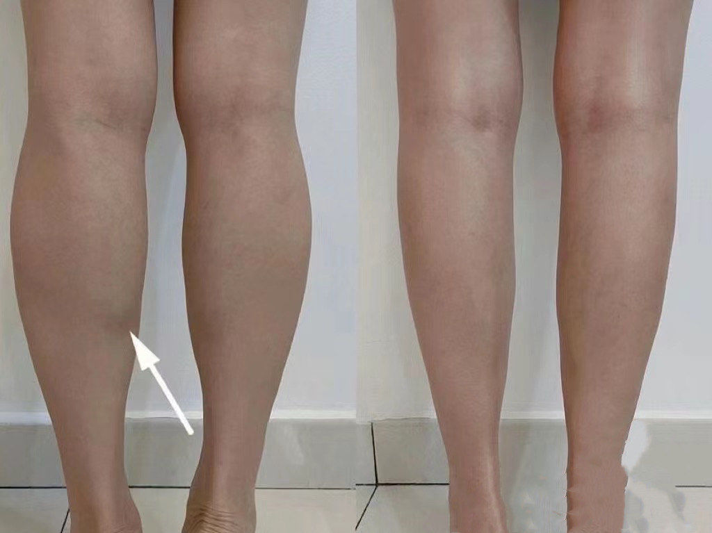 腿部塑形2个月效果