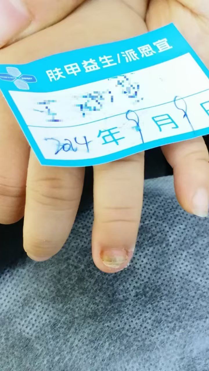 小朋友灰指甲