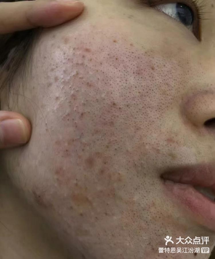 毛孔长期堵塞不仅毛孔变大还会容易细菌滋生繁殖反复长痘出