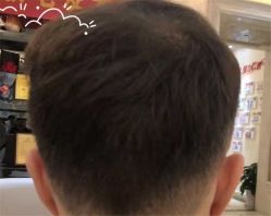 -大麦微针植发全国连锁