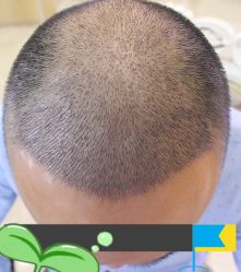 -大麦微针植发丨全国连锁