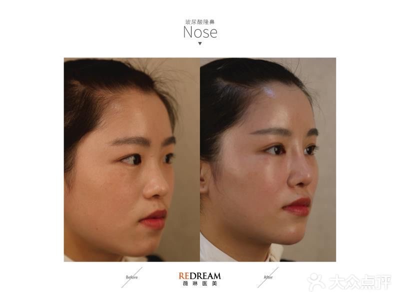 玻尿酸的功效真是太强大了！！