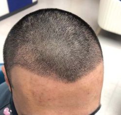 -大麦微针植发丨全国连锁