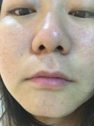 -成都苗方清颜专业祛痘