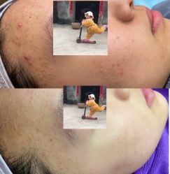 -蕾特恩专业祛痘国际连锁