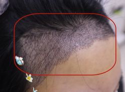 -大麦微针植发全国连锁