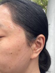 -爱莎扁平疣·汗管瘤·斑痣中心
