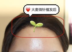 -大麦微针植发全国连锁