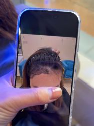 -碧莲盛·不剃发植发