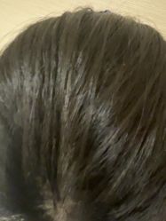 -碧莲盛·不剃发植发