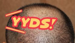 -大麦微针植发丨全国连锁