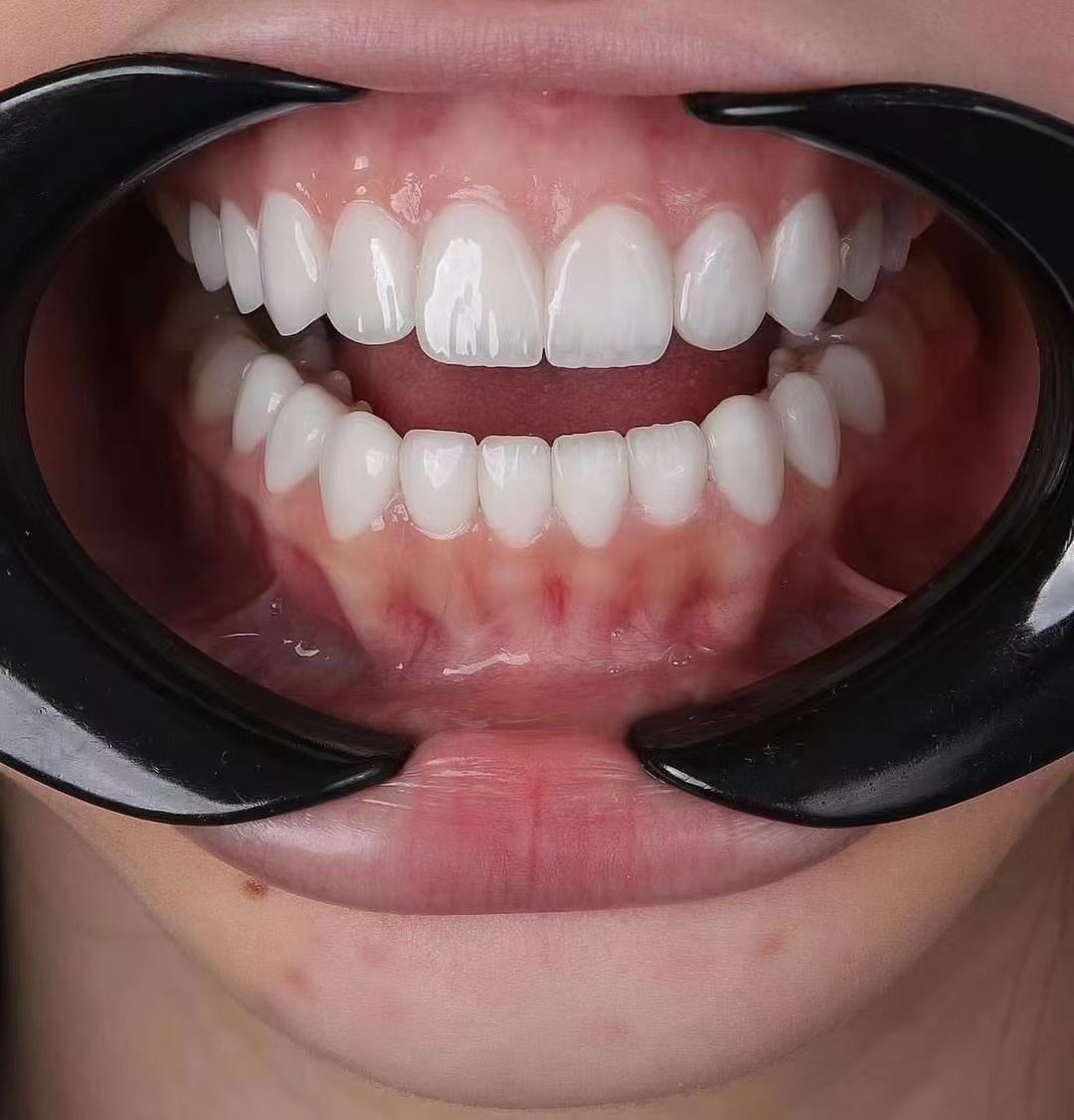 亮白牙齿自然闪耀