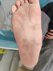 -德哥灰指甲脚气甲沟炎跖疣护理
