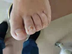 -世龙世家灰指甲鸡眼脚气甲沟炎跖疣护理(通州店)