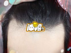 -大麦微针植发全国连锁