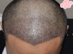 -大麦微针植发丨全国连锁