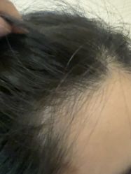 -碧莲盛·不剃发植发