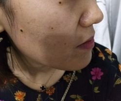 点击看大图 -北京美痣堂古方祛痣斑疣瘊