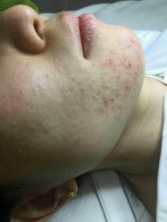 点击看大图 -苗方清颜痘肌研究所