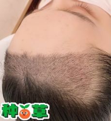 -大麦微针植发丨全国连锁