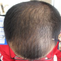 -大麦微针植发丨全国连锁