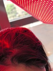 -碧莲盛·不剃发植发