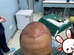 点击看大图 -大麦微针植发丨全国连锁