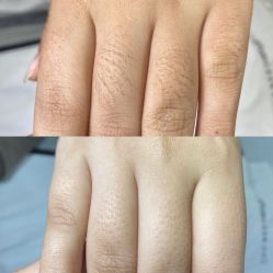 -薇兰专业脱毛连锁机构