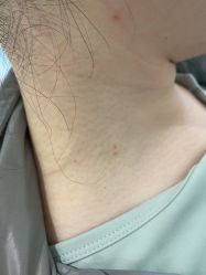 -爱莎扁平疣·汗管瘤·斑痣中心